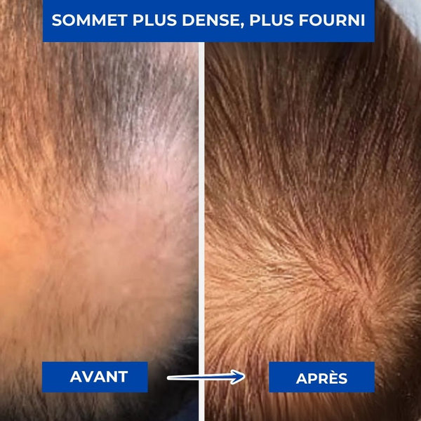 Oflure™ Micro‑Infuse - Densité & Repousse Capillaire.